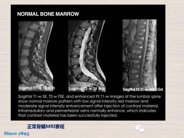 【PPT】骨髓病变的磁共振成像【ECR精选】