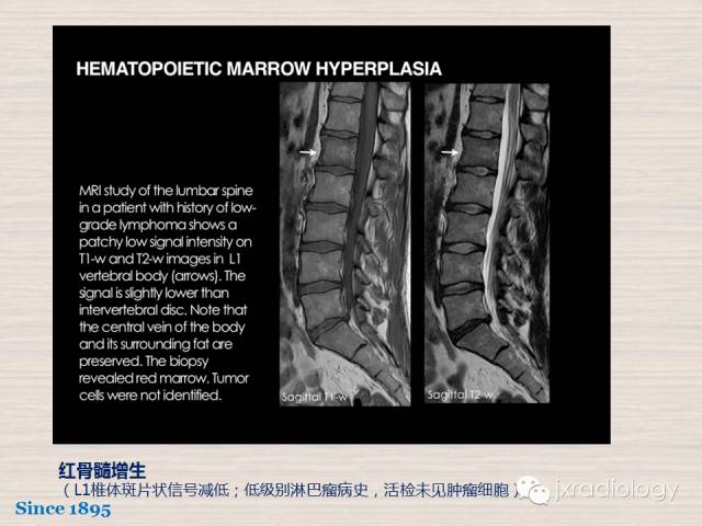 【PPT】骨髓病变的磁共振成像【ECR精选】