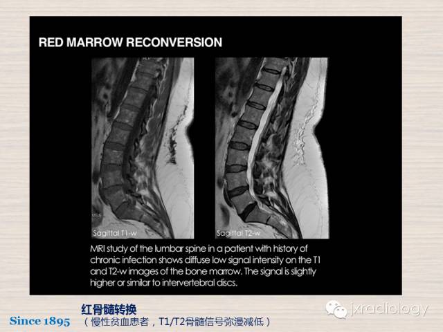 【PPT】骨髓病变的磁共振成像【ECR精选】