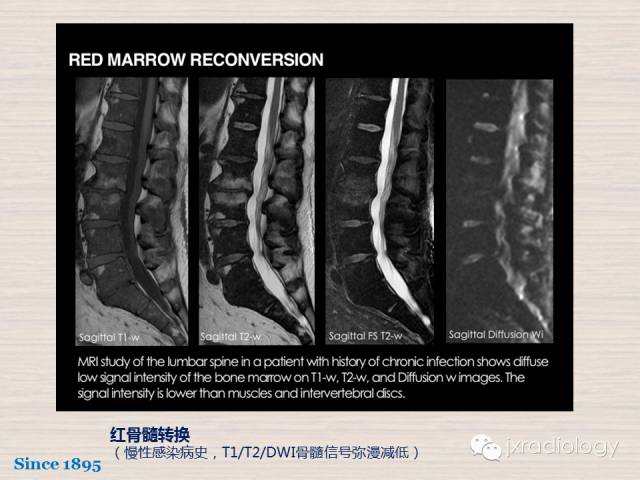 【PPT】骨髓病变的磁共振成像【ECR精选】