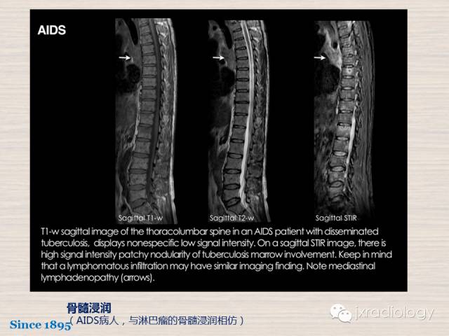 【PPT】骨髓病变的磁共振成像【ECR精选】