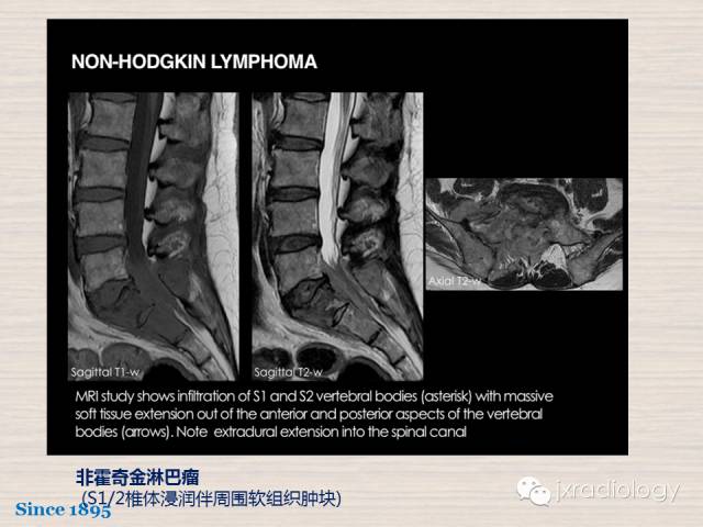 【PPT】骨髓病变的磁共振成像【ECR精选】