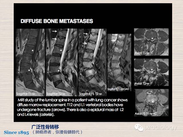 【PPT】骨髓病变的磁共振成像【ECR精选】