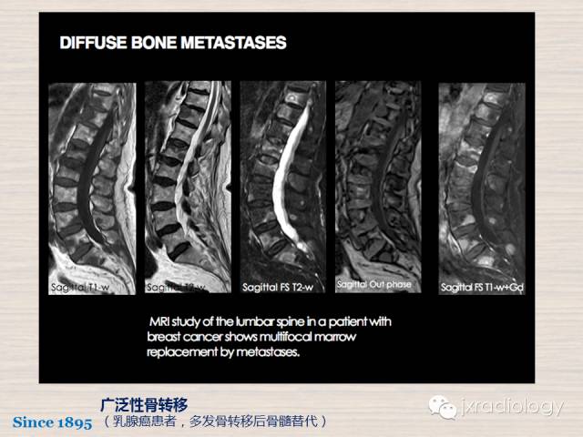 【PPT】骨髓病变的磁共振成像【ECR精选】