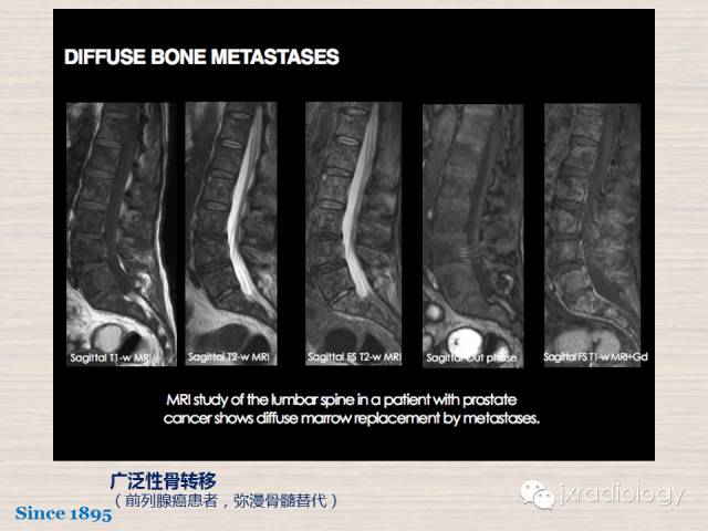 【PPT】骨髓病变的磁共振成像【ECR精选】