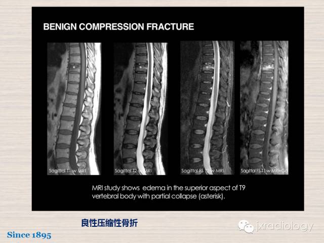 【PPT】骨髓病变的磁共振成像【ECR精选】