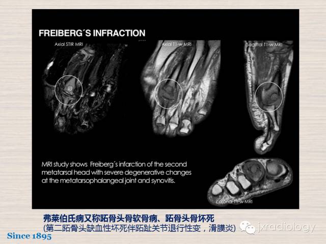 【PPT】骨髓病变的磁共振成像【ECR精选】