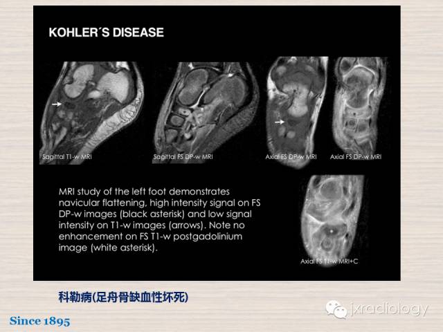 【PPT】骨髓病变的磁共振成像【ECR精选】