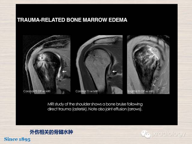 【PPT】骨髓病变的磁共振成像【ECR精选】