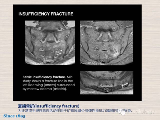 【PPT】骨髓病变的磁共振成像【ECR精选】