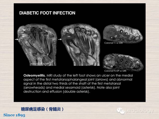 【PPT】骨髓病变的磁共振成像【ECR精选】