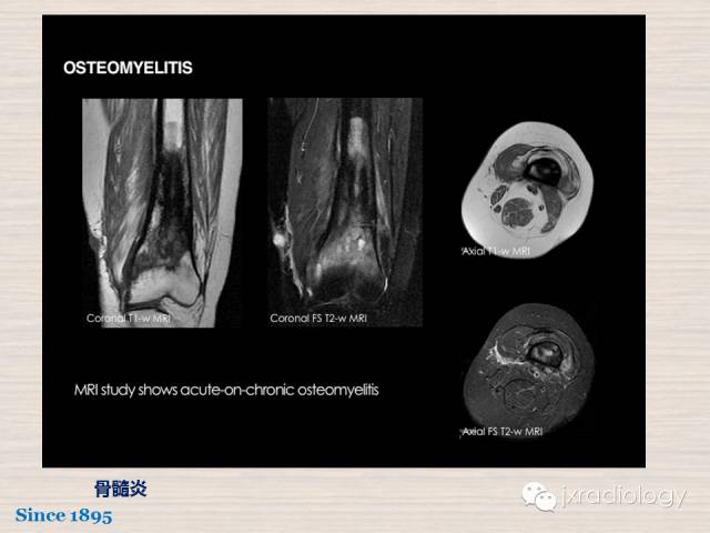 【PPT】骨髓病变的磁共振成像【ECR精选】