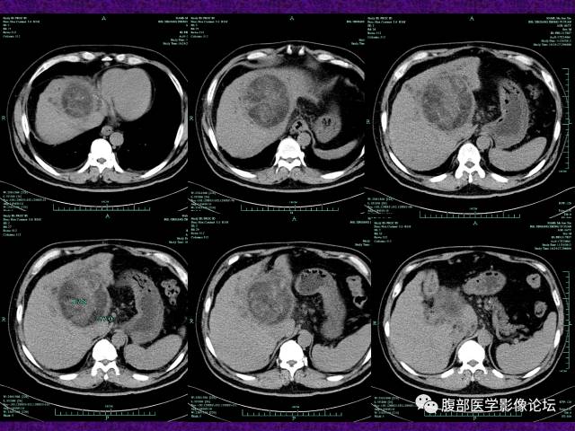 【病例】混合性肝细胞癌-胆管细胞癌1例CT