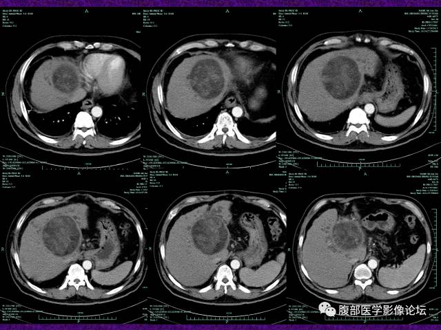 【病例】混合性肝细胞癌-胆管细胞癌1例CT