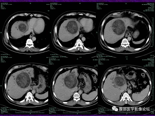 【病例】混合性肝细胞癌-胆管细胞癌1例CT