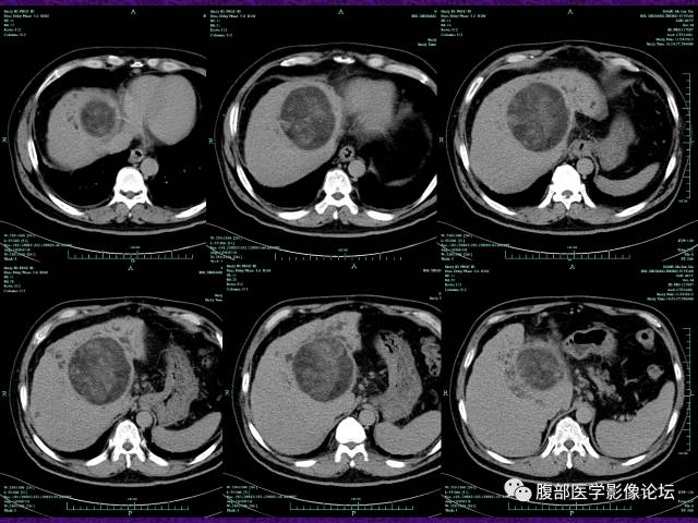 【病例】混合性肝细胞癌-胆管细胞癌1例CT