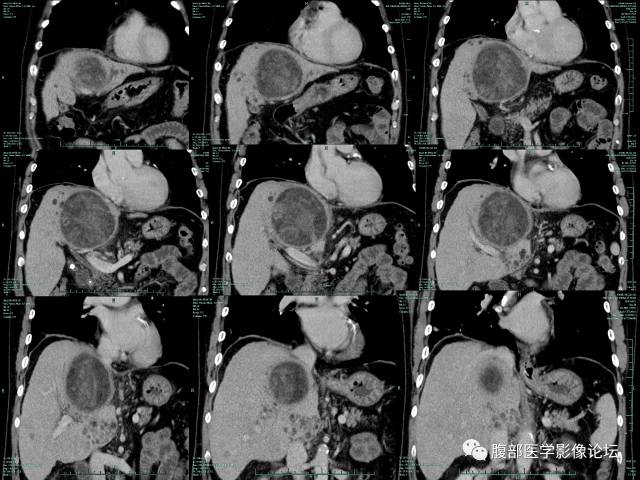 【病例】混合性肝细胞癌-胆管细胞癌1例CT