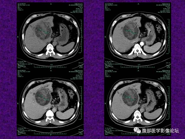 【病例】混合性肝细胞癌-胆管细胞癌1例CT