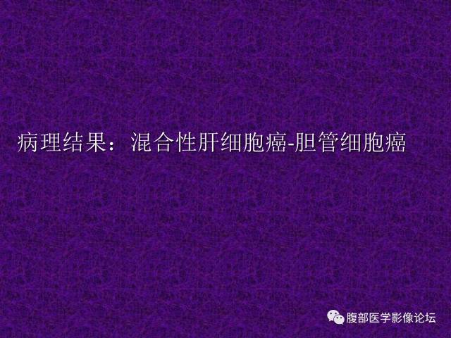 【病例】混合性肝细胞癌-胆管细胞癌1例CT