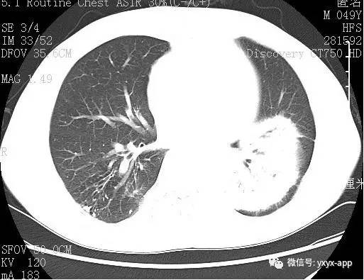 【病例】肺淋巴瘤1例CT影像表现