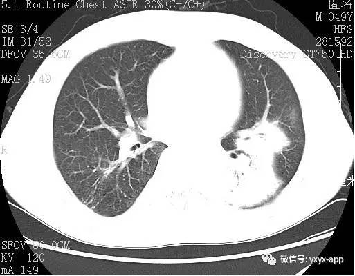 【病例】肺淋巴瘤1例CT影像表现