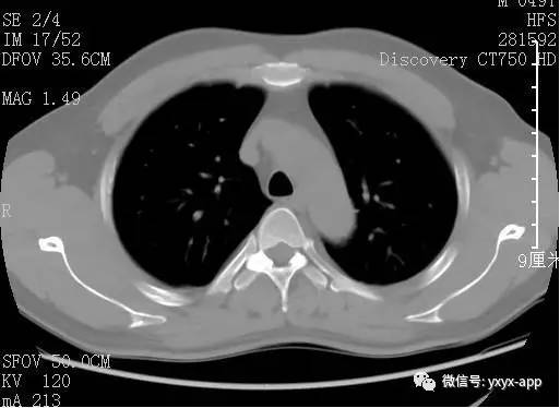 【病例】肺淋巴瘤1例CT影像表现