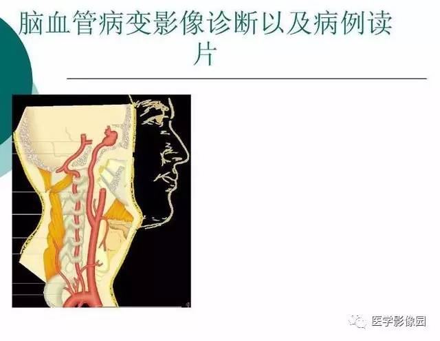 【PPT】脑血管病变影像诊断以及病例读片