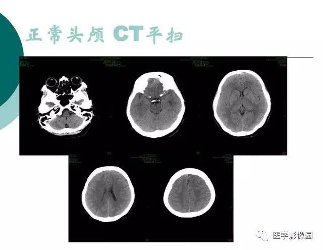 【PPT】脑血管病变影像诊断以及病例读片