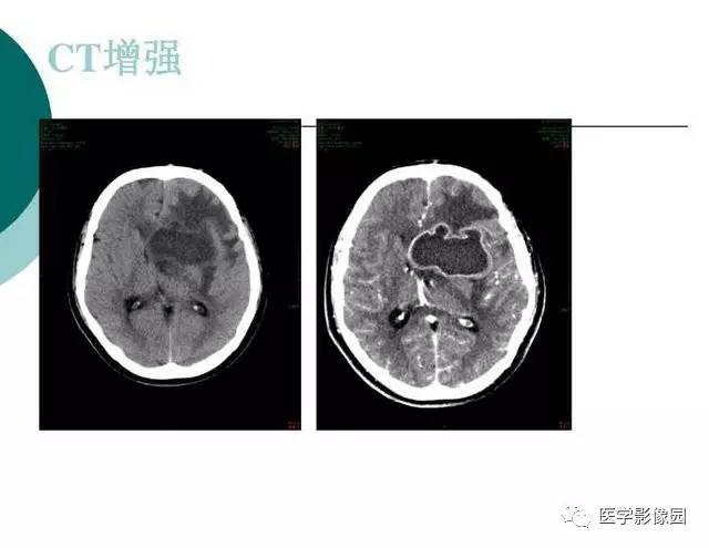 【PPT】脑血管病变影像诊断以及病例读片