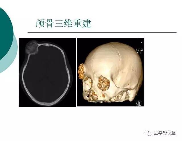【PPT】脑血管病变影像诊断以及病例读片
