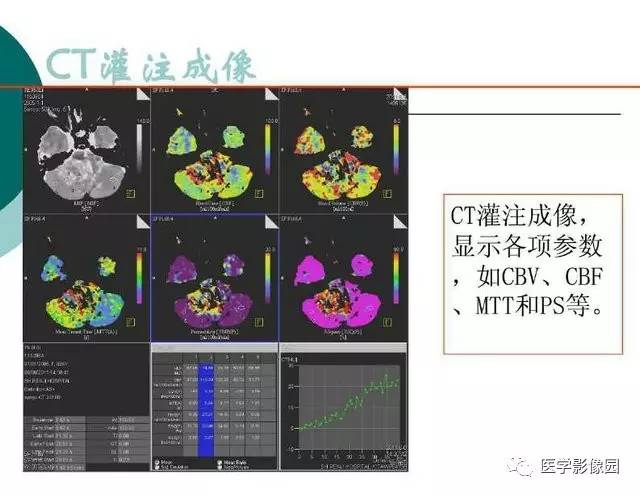 【PPT】脑血管病变影像诊断以及病例读片