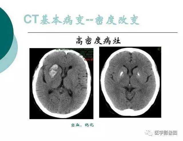 【PPT】脑血管病变影像诊断以及病例读片