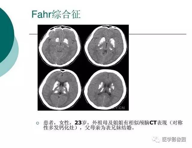 【PPT】脑血管病变影像诊断以及病例读片