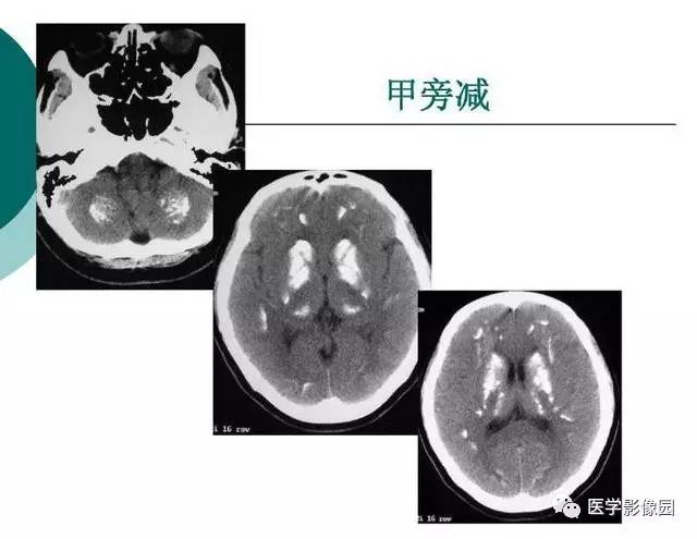 【PPT】脑血管病变影像诊断以及病例读片