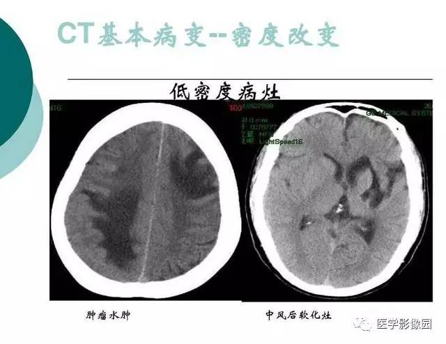 【PPT】脑血管病变影像诊断以及病例读片