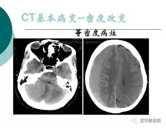 【PPT】脑血管病变影像诊断以及病例读片