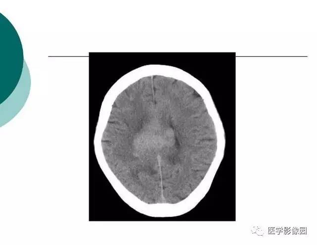 【PPT】脑血管病变影像诊断以及病例读片