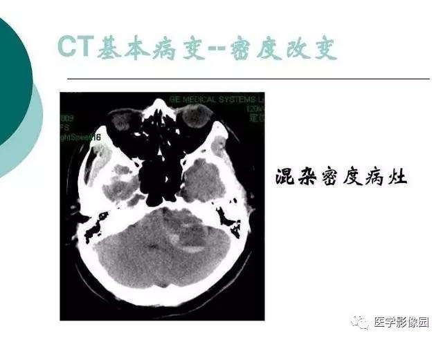 【PPT】脑血管病变影像诊断以及病例读片