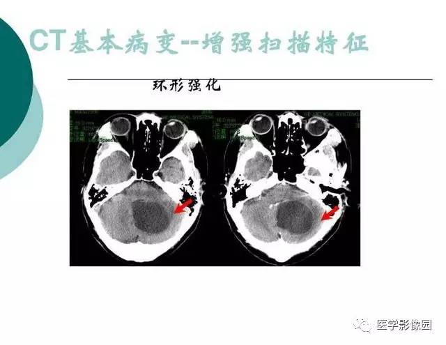 【PPT】脑血管病变影像诊断以及病例读片