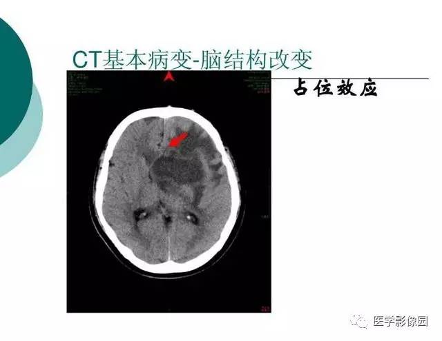 【PPT】脑血管病变影像诊断以及病例读片