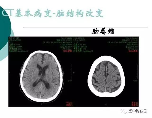 【PPT】脑血管病变影像诊断以及病例读片