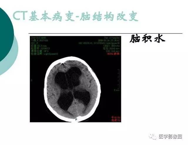 【PPT】脑血管病变影像诊断以及病例读片