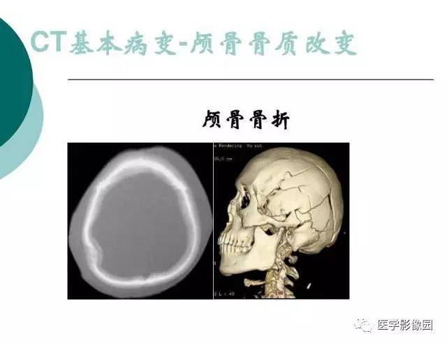 【PPT】脑血管病变影像诊断以及病例读片