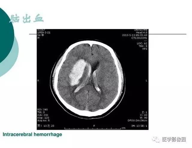 【PPT】脑血管病变影像诊断以及病例读片