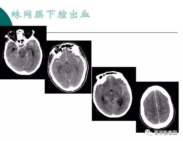 【PPT】脑血管病变影像诊断以及病例读片