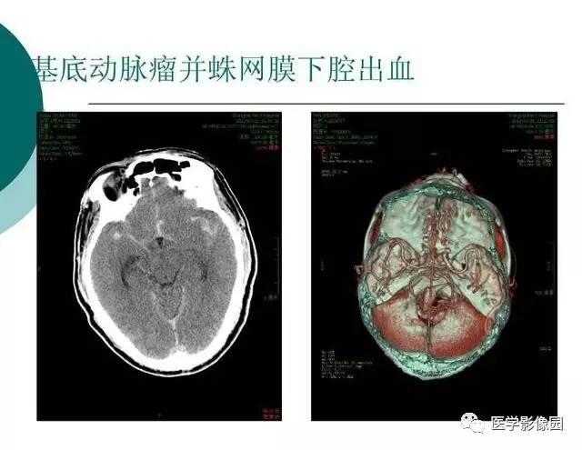 【PPT】脑血管病变影像诊断以及病例读片