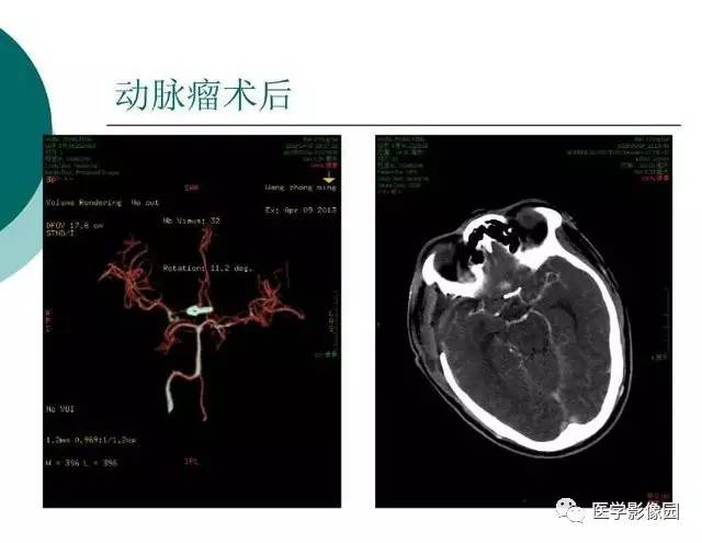 【PPT】脑血管病变影像诊断以及病例读片