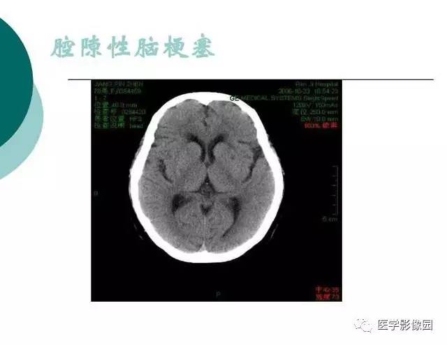 【PPT】脑血管病变影像诊断以及病例读片