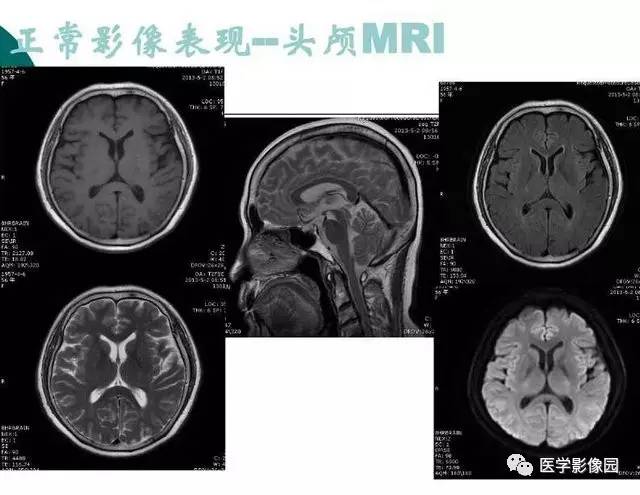 【PPT】脑血管病变影像诊断以及病例读片