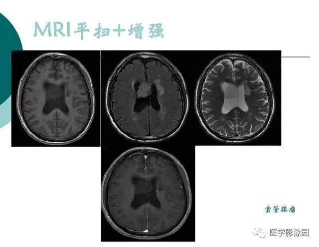 【PPT】脑血管病变影像诊断以及病例读片